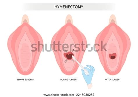 Surgery Procedure Medical Types Hymen Hymenoplasty Shutterstock