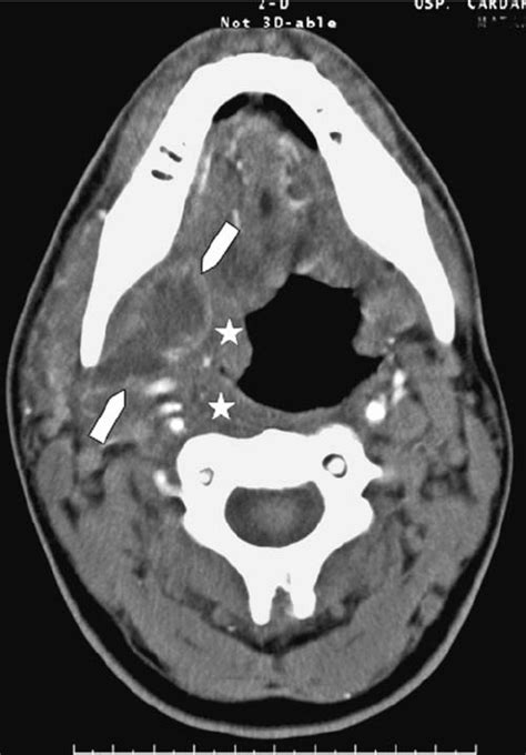 A 29 Year Old Man Presenting With A Palpable Submandibular Neck Mass