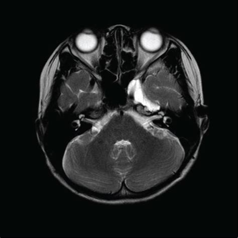 Brain Mri Revealing Inflammatory Lesions In Sphenoid Bone After The
