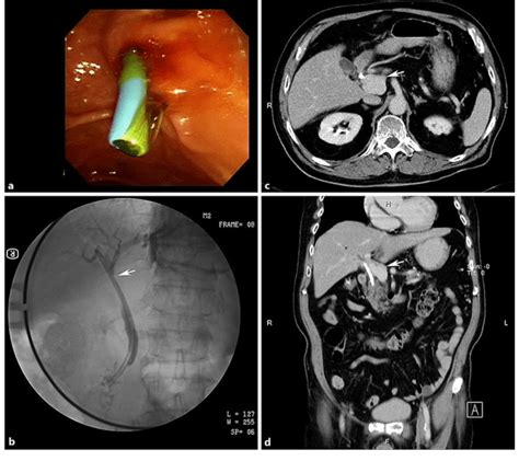 A Insertion Of A Biliary Plastic Stent Into The Common Bile Duct B