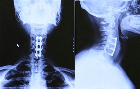 Full Range Of Surgical Options For Cervical Spinal Stenosis