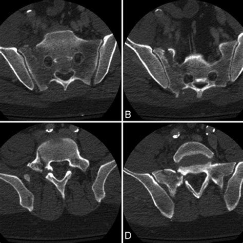 The Denis Classification Of Sacral Fractures A The 3 Zones Zone I