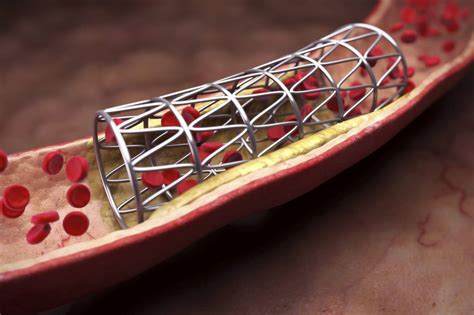 Which Heart Patients Need Stents A New Study Stirs Debate Wsj