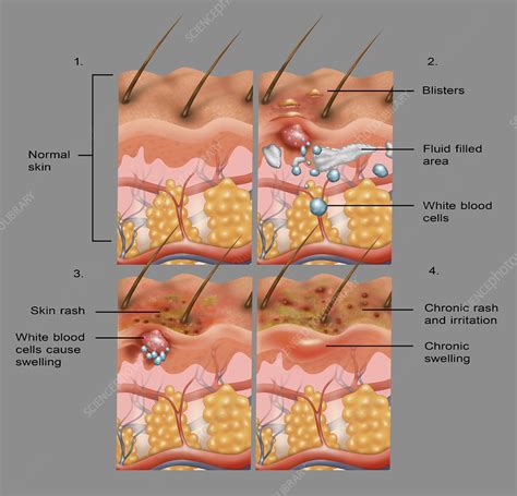 Eczema Illustration Stock Image F0317175 Science Photo Library