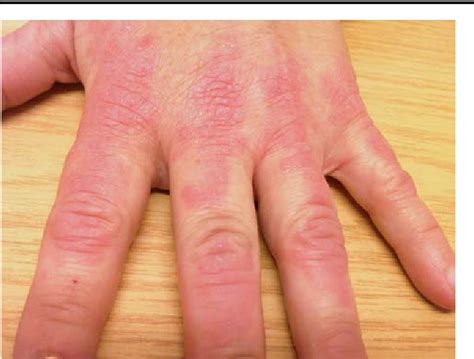 Fig 2 A Photograph Showing The Left Hand Of The Patient With A Rash Characterized By An