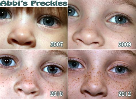 Freckle Progression