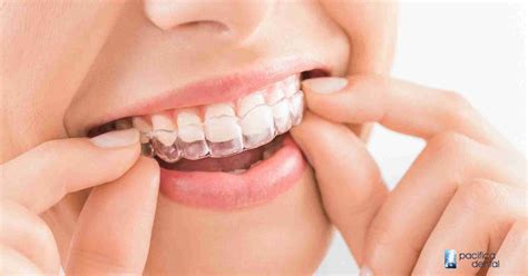 The Benefits Of Clear Aligners Pacifica Dental