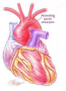 Aneurysm, widening of an artery that develops from a weakness or destruction of the medial layer of the blood vessel. Aortic Aneurysm Surgery