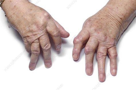 Rheumatoid Arthritis Of The Fingers Stock Image C0166941 Science