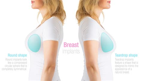 Bilder Bruststraffung Mit Implantaten Wundersch Ne Pornofotos
