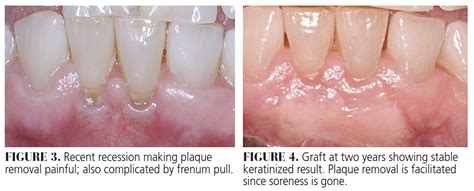 Maintaining Palatal Comfort Following Gingival Grafting Decisions In