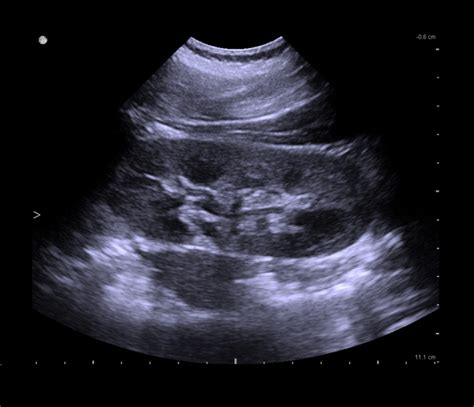 Ultrasound Machines For Kidney Imaging Bk Medical