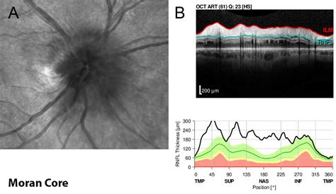 Moran Core Non Arteritic Ischemic Optic Neuropathy Naion Case 01