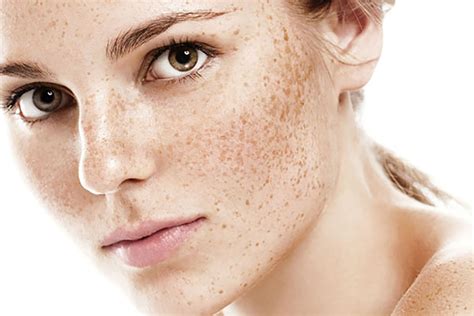 The Difference Between Freckles And Moles What You Need To Know Justinboey