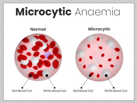 Microcytic Anemia Symptoms Causes Risk Factors Treatment And
