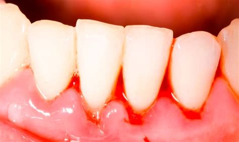 Causas Del Sangrado De Enc As Y Como Tratarlo Cl Nica Dental Centro