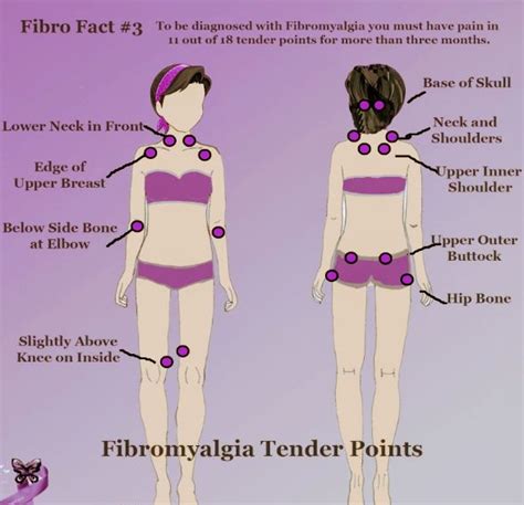 Photo Google Photos Fibromyalgia Fibromyalgia Trigger Points Fibromyalgia Symptoms