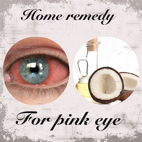How To Cure Pink Eye From Home At Home Remedy For Pink Eye Musely