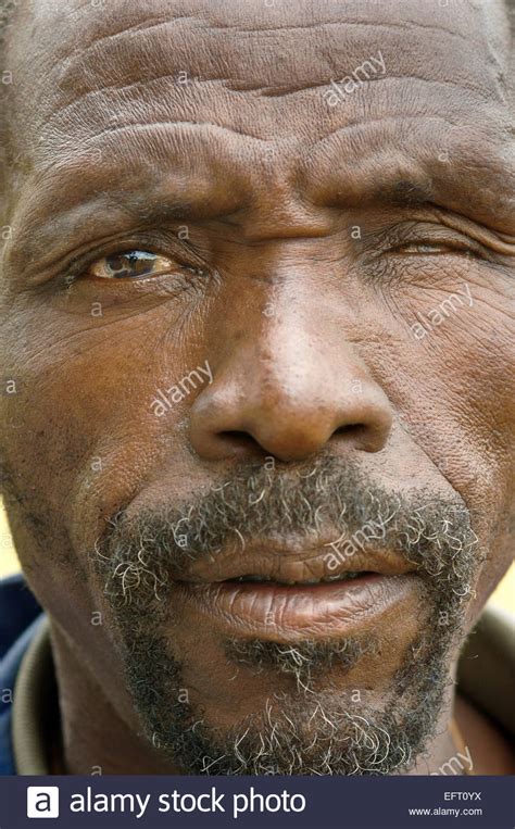 Man Portrait Blind In One Eye Blindness Real People Person Human Stock