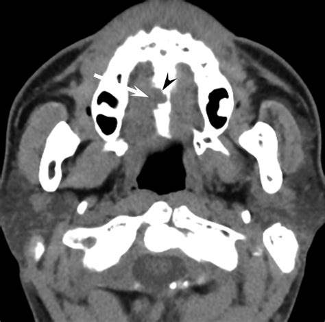 Ct And Mr Imaging Findings Of Palatal Tumors European Journal Of