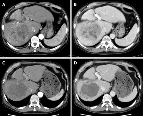 Successful Hepatic Resection For Recurrent Hepatocellular Carcinoma