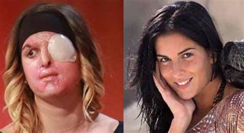 Gessica notaro received severe burns to her face in january when she was doused in hydrochloric acid. Gessica Notaro, i giudici: «Tavares la sfregiò per levarle ...