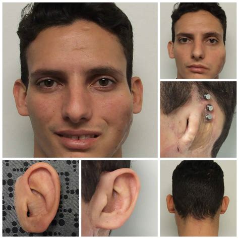 Microtia Ear Prosthetics Feel More Confident And Comfortable