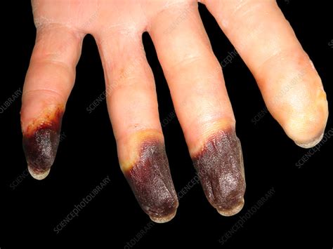 Dedo Do Pé Necrosado