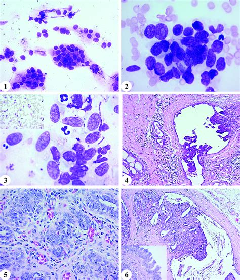 Cytology Of Adenoma Clusters Of Epithelial Cells Showing Mild Cellular Download Scientific