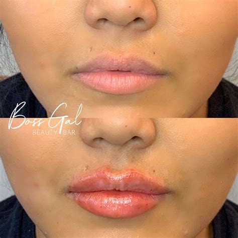 Another Beautiful Result On Our Boss Gal Client With Lip Filler We