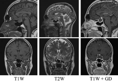 pituitary mri indicating macroadenoma 2 8 1 8 1 8 cm in size with download scientific