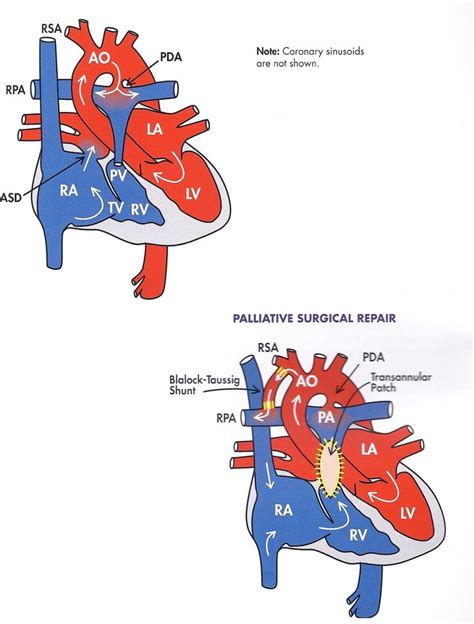 27 Best Hypoplastic Right Heart Syndrome Images On Pinterest