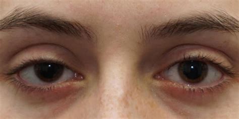 First Prescription Fix For Droopy Eyelid American Academy Of