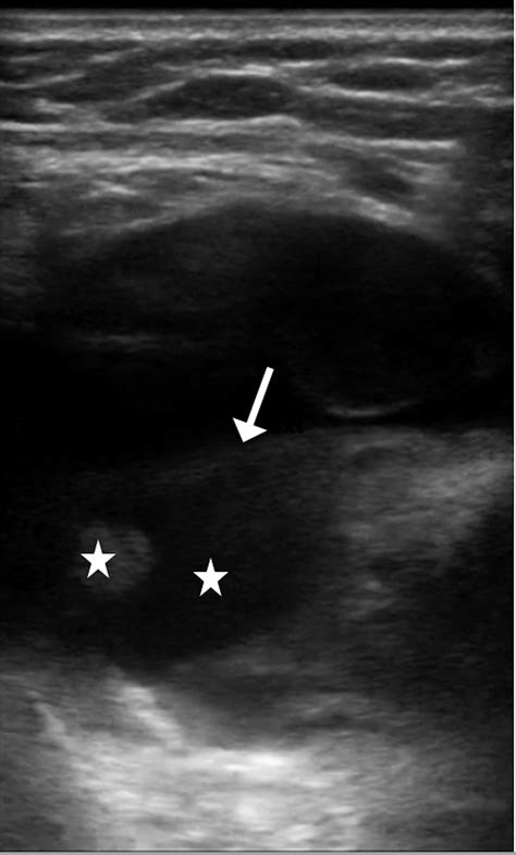 Woman With Unilateral Facial Swelling Annals Of Emergency Medicine