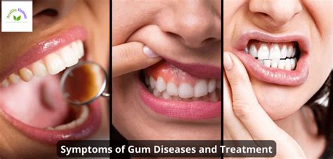 Periodontitis Gum Diseases Symptoms And Treatment