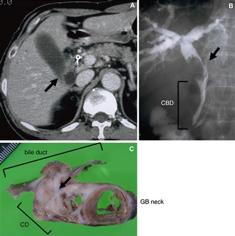 New Classification Of Cystic Duct Carcinoma Springerlink