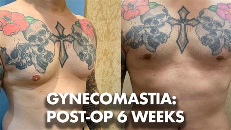 Gynecomastia Surgery Results Weeks Post Op Dr Lebowitz Youtube