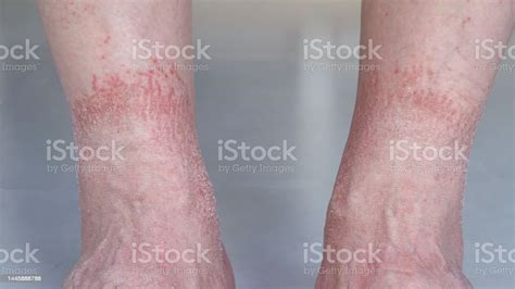 Ankles Dermatitis Stock Photo Download Image Now Leg Eczema Skin