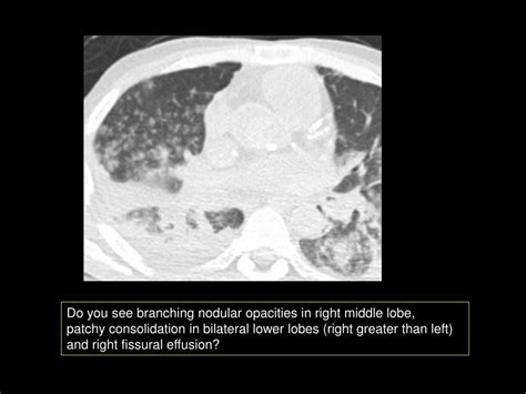 Ppt Image Gallery Lesion Detection On Low Dose Chest Ct Powerpoint Presentation Id