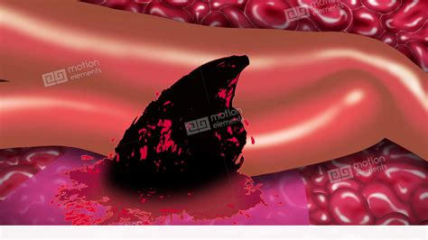 Blood Vessel Rupture Stock Animation 11506942