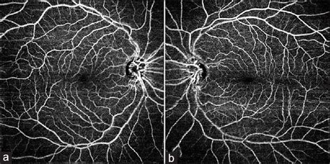 The Peculiar Pattern Of Retinal Vessels Being Better Appreciated On The Download Scientific