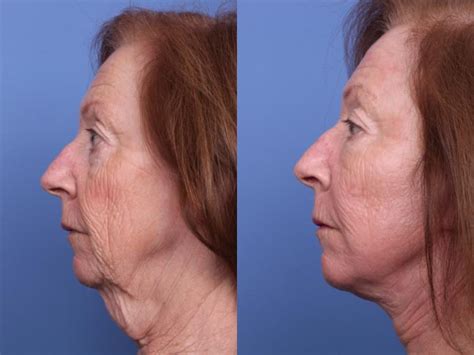Facelift Before And After Pictures Case 240 Scottsdale Az Hobgood Facial Plastic Surgery
