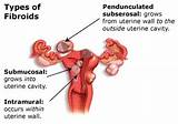 Fibroid Removal Surgery Recovery Pictures