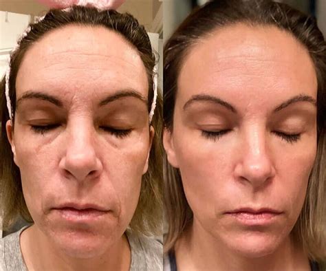 Red Light Therapy Before And After Solawave Red Light Therapy Light Therapy Facial Treatment