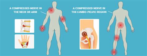 Can A Pinched Nerve In Your Neck Cause Arm Pain