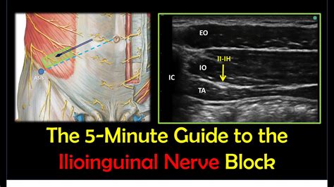 Ilioinguinal Nerve Block A How To Guide Youtube
