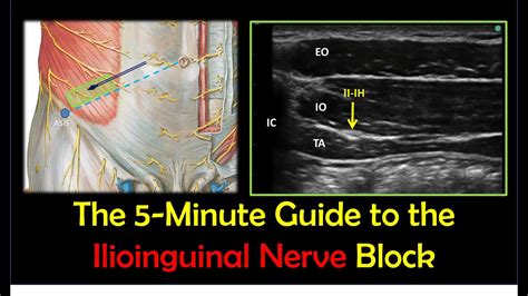 Ilioinguinal Nerve Block Ultrasound