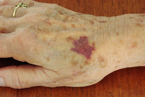 Investigating easy bruising in an adult | The BMJ
