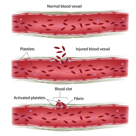 What Is Thrombosis General Information