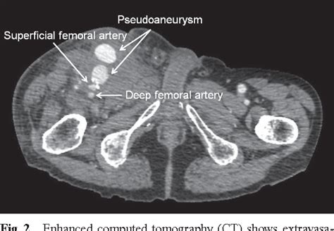 Figure 1 From Spontaneous Rupture Of Superficial Femoral Artery